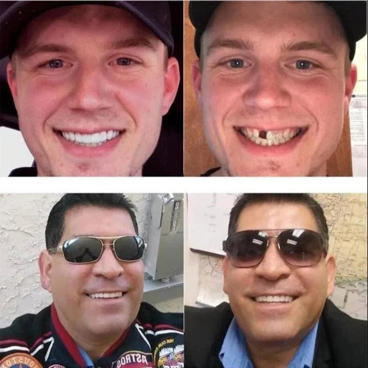 Adjustable Cosmetic Smile Veneers, Upper & Lower Set