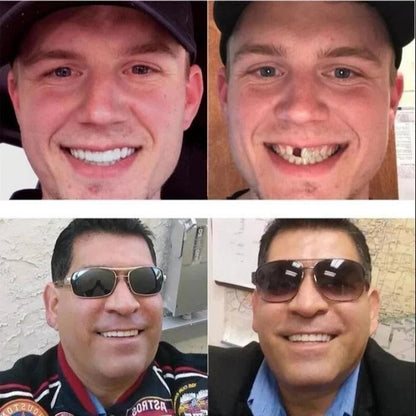 Adjustable Cosmetic Smile Veneers, Upper & Lower Set